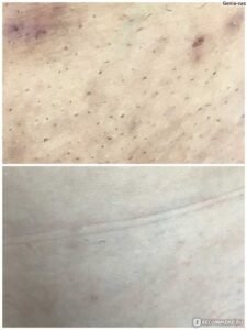 Аллергия после лазерной эпиляции Ташкент Аллергия после лазерной эпиляции Ташкент