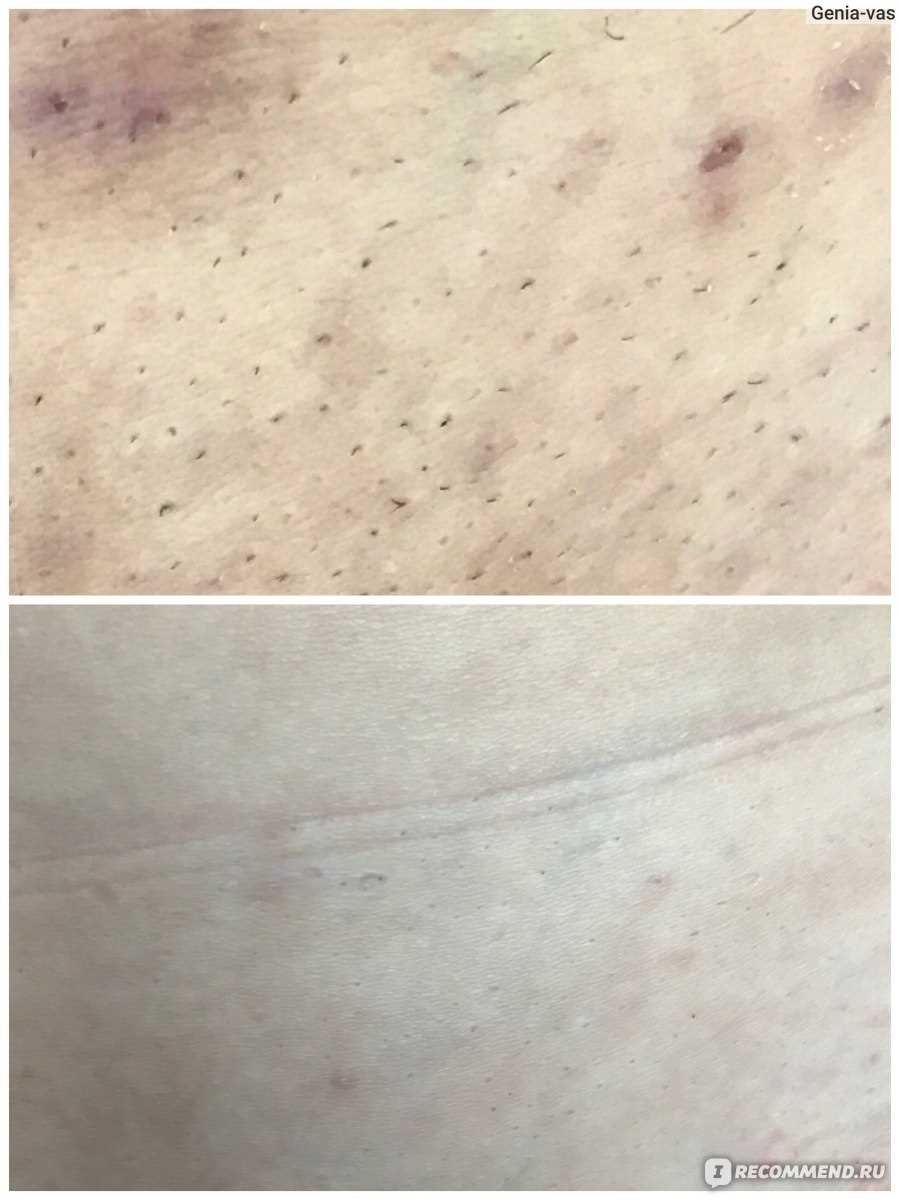 Отличия лазерной эпиляции в различных клиниках Ташкента