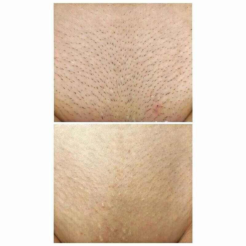 Сравнение различных методов бразильской эпиляции