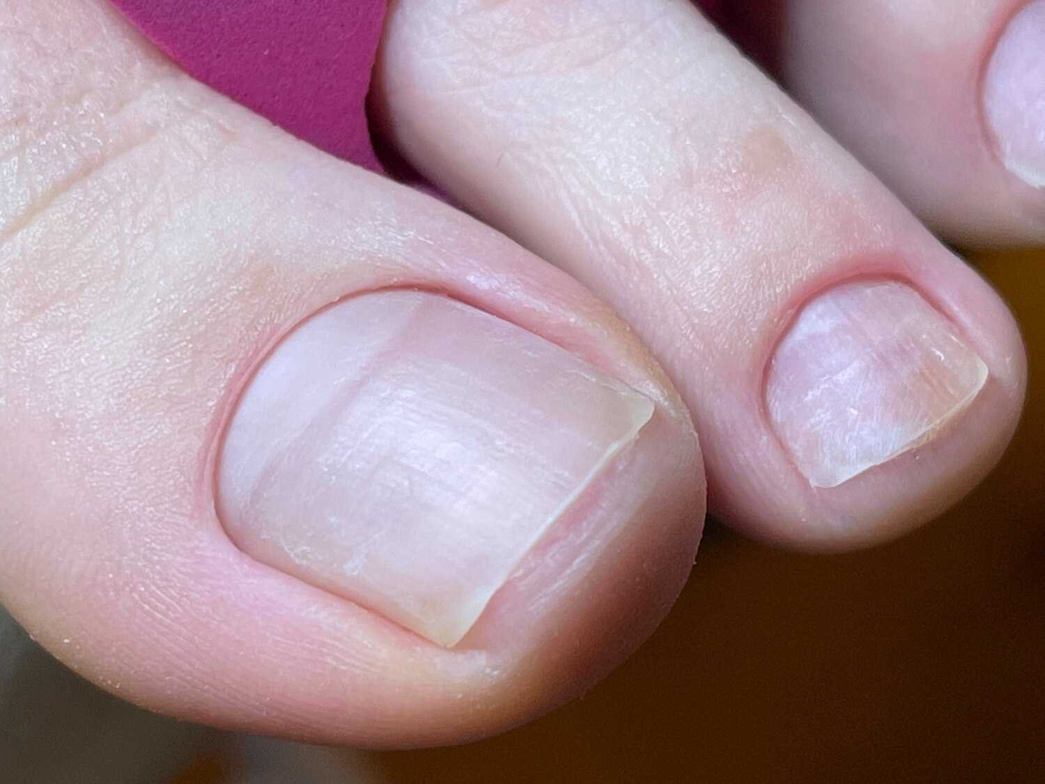 Методы лечения и коррекции бугристых ногтей