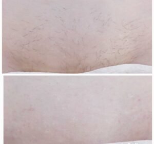 Депиляция глубокого бикини воском Ташкент