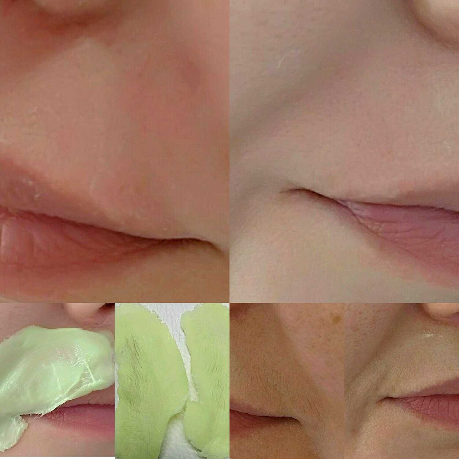 Возможные противопоказания для восковой депиляции шеи