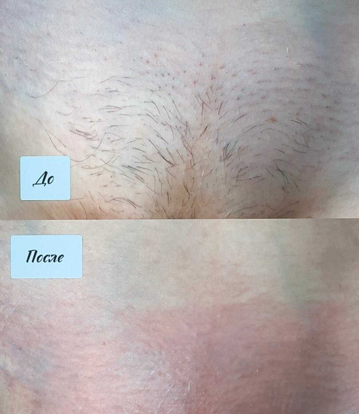 Советы по минимизации дискомфорта во время процедуры