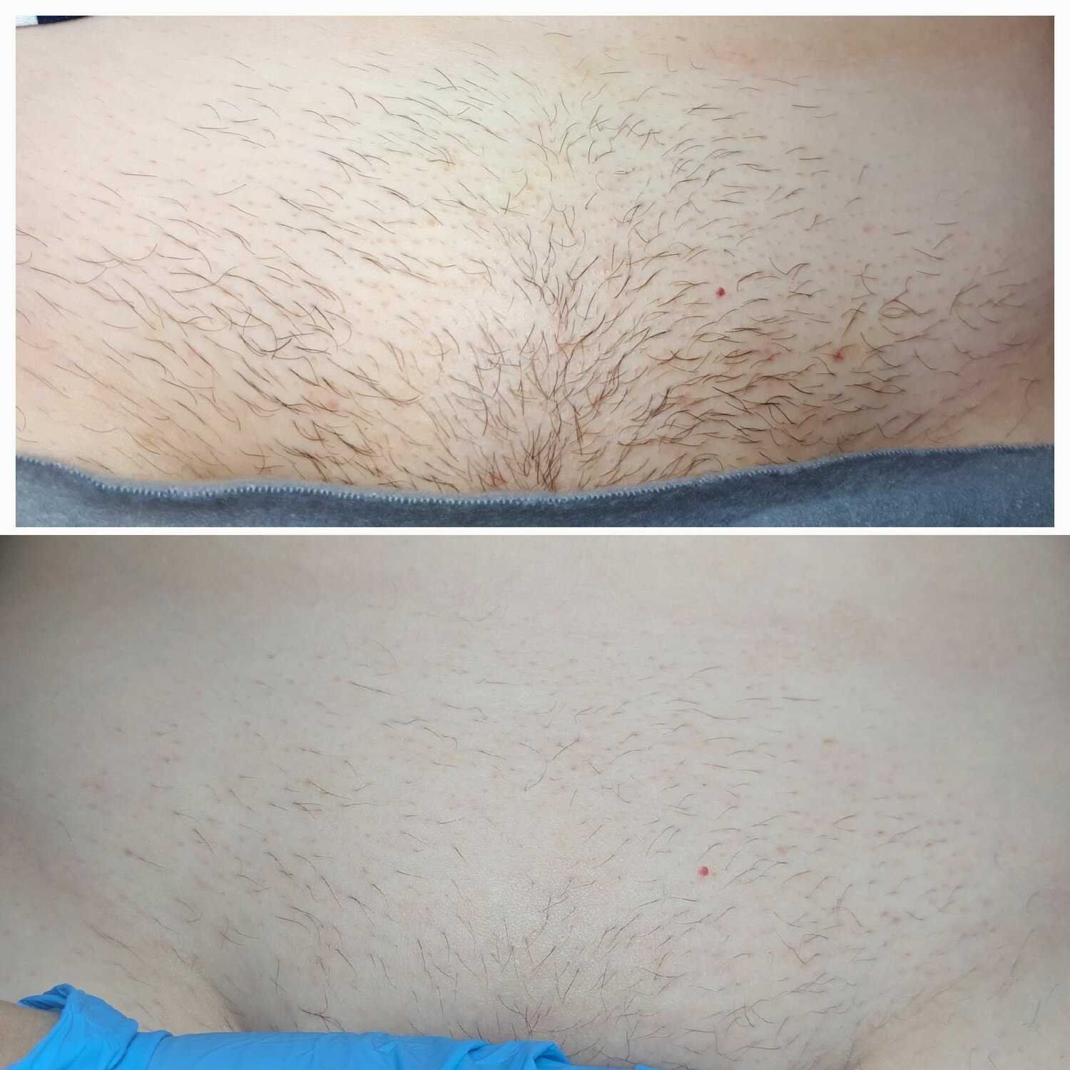 После ухода за кожей после депиляции глубокого бикини