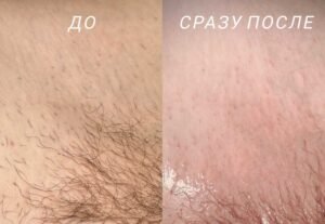 Электроэпиляция бикини сколько времени Ташкент