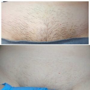 Электроэпиляция глубокое бикини Ташкент