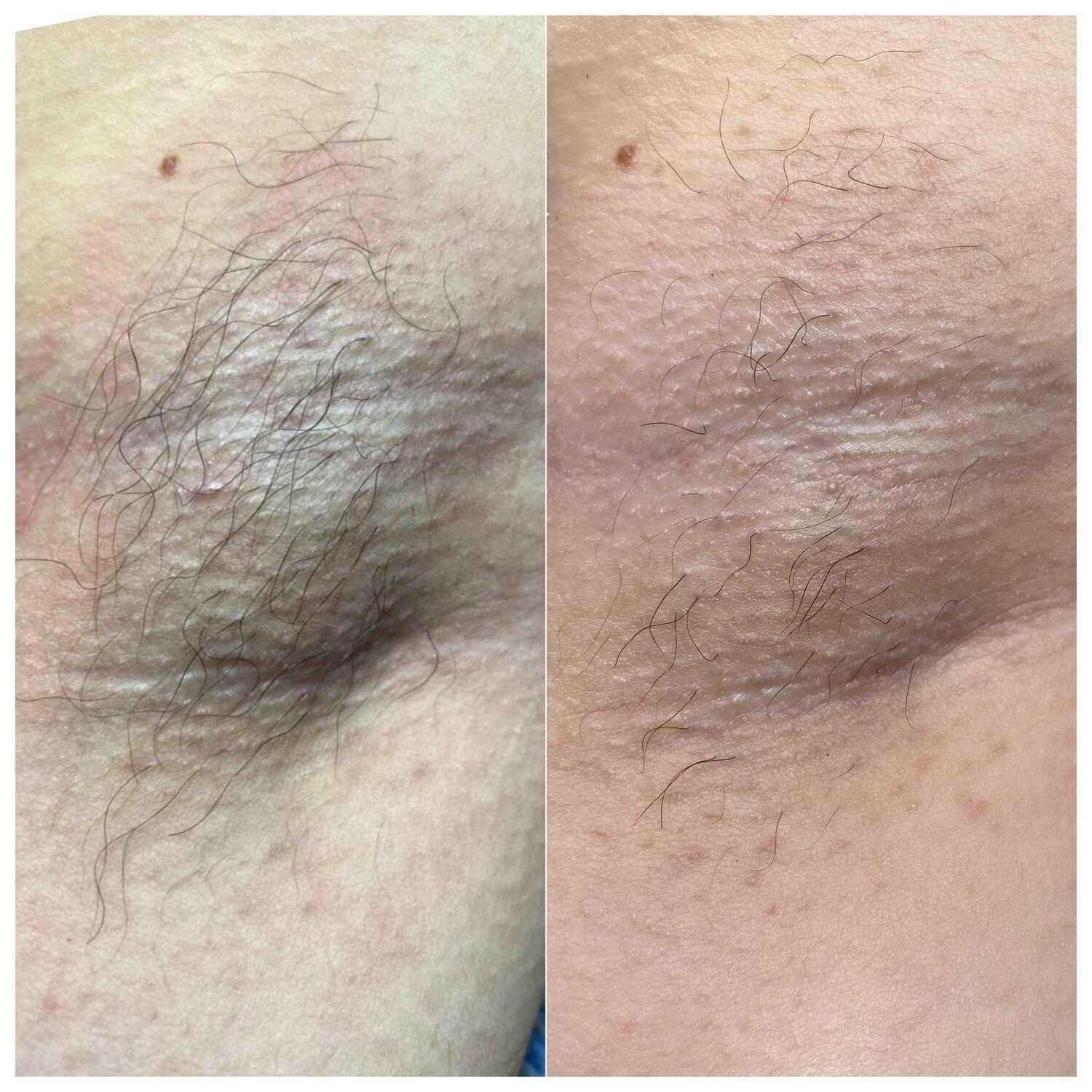 Специальные предложения и скидки на электроэпиляцию