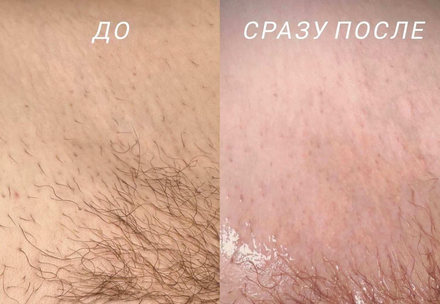 Рекомендации по подготовке к процедуре электроэпиляции бикини