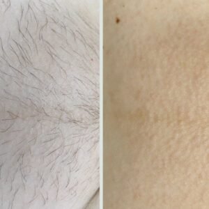 Электроэпиляция цена бикини Ташкент