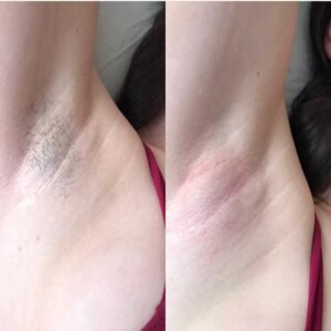 Эпиляция подмышек воском Ташкент