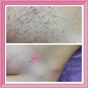 Как сделать депиляцию лобка Ташкент