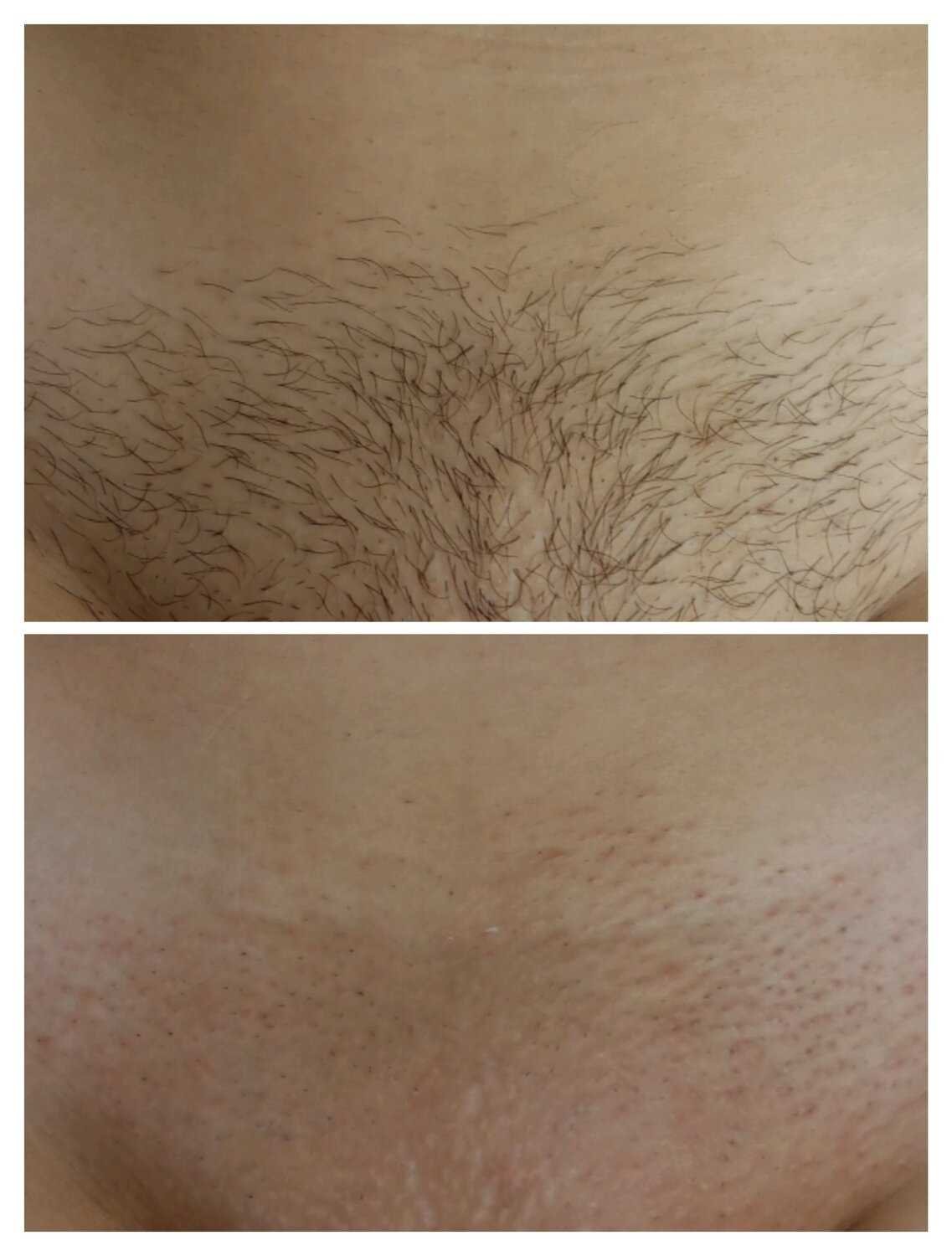 Популярные вопросы о шугаринге бикини