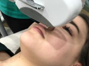 Лазерная эпиляция верхней губы Ташкент