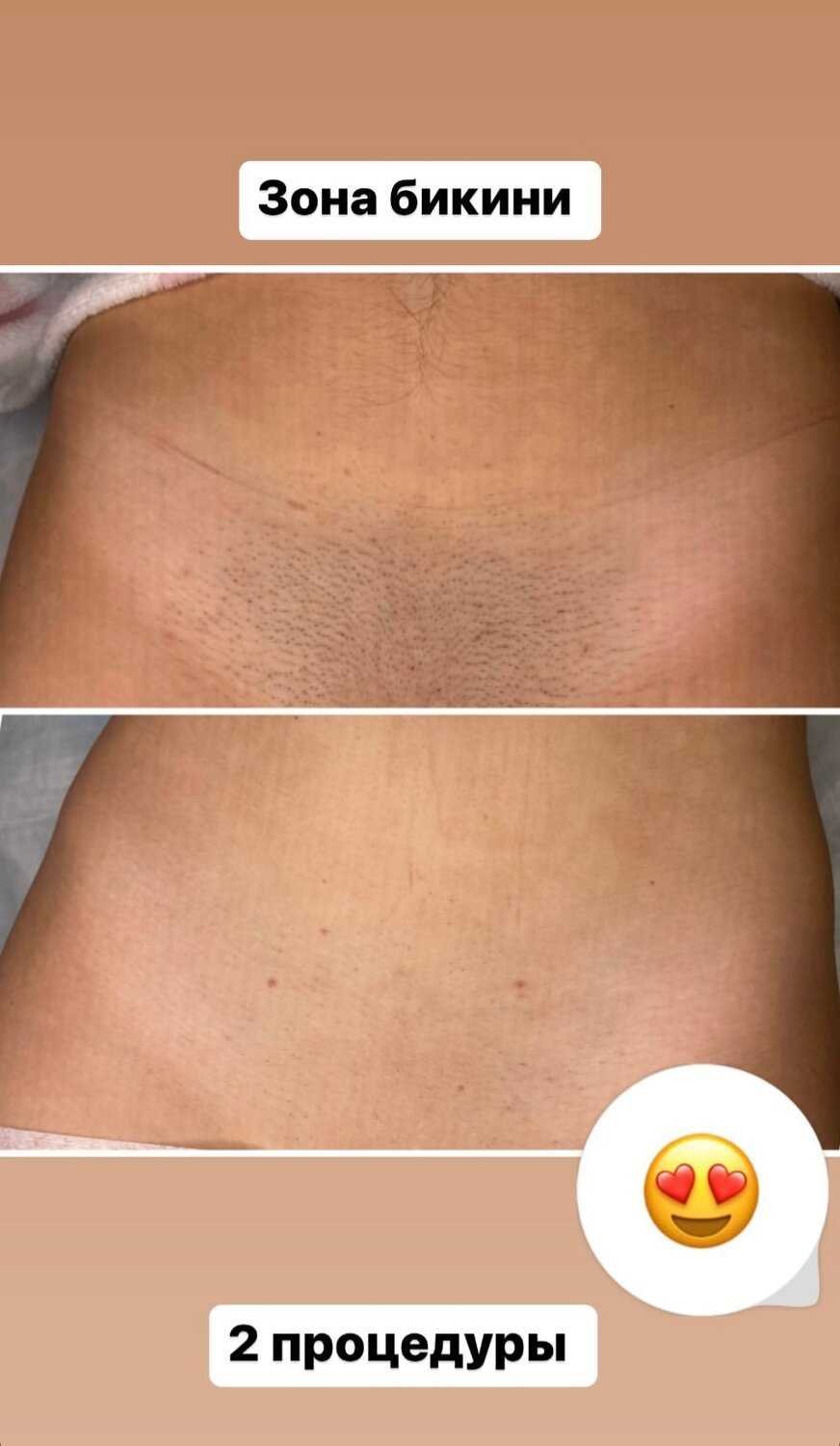Стоимость лазерной эпиляции зоны бикини в Ташкенте