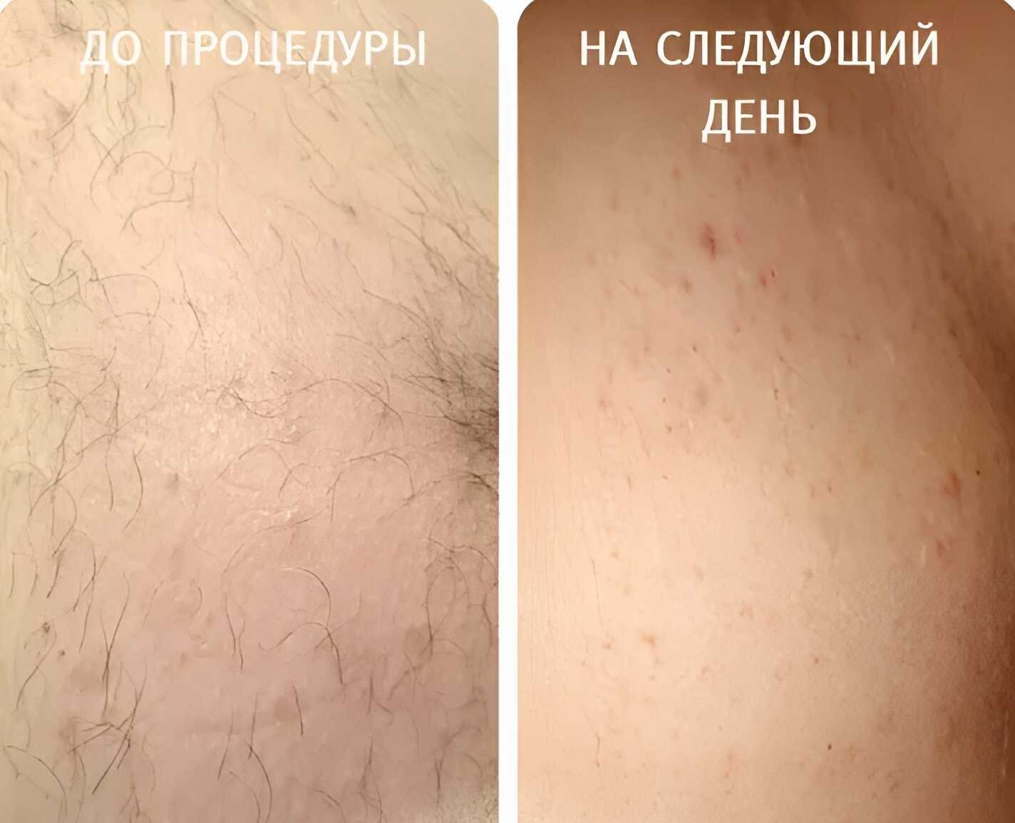 Что учесть перед первой процедурой электроэпиляции?