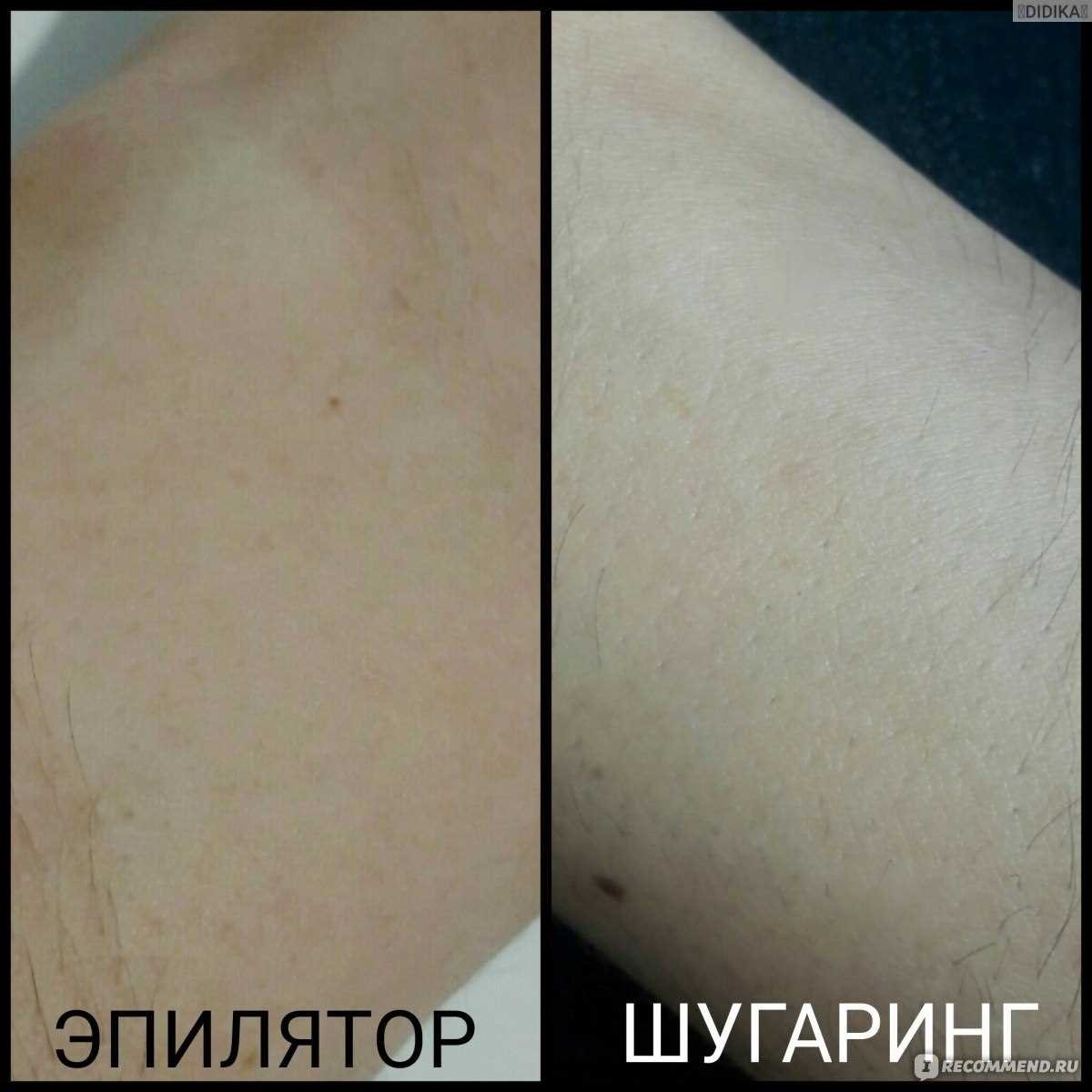 Как возраст и тип кожи влияют на срок действия шугаринга?