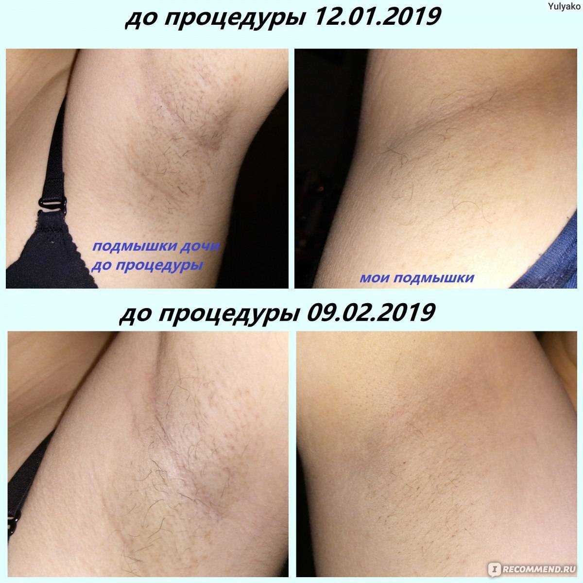 Факторы, влияющие на продолжительность результата шугаринга