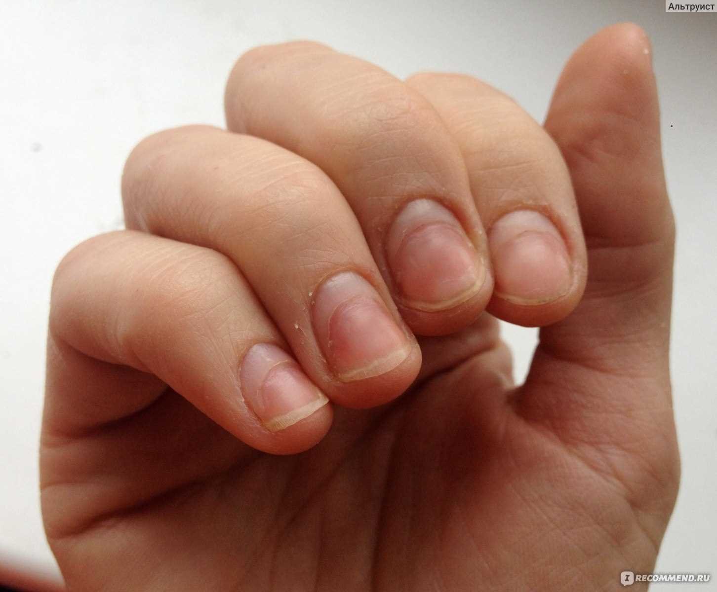 Домашние средства для лечения пропила ногтя