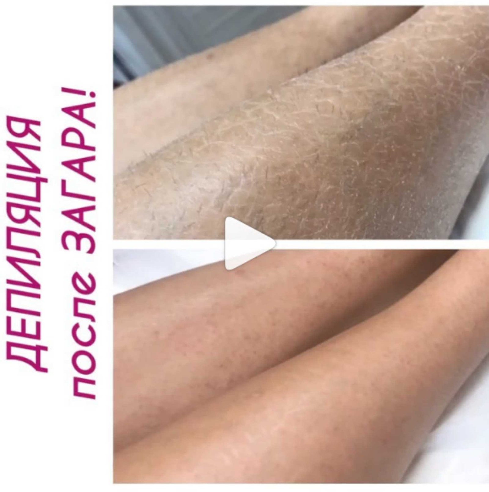 Что нужно знать о послеуходе за кожей после депиляции