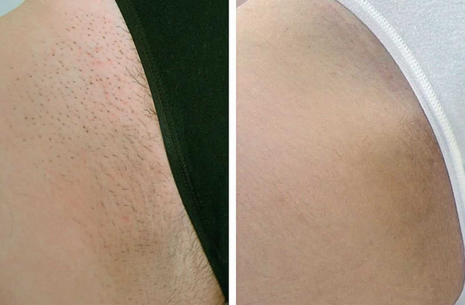 Сравнение методов депиляции: восковая, сахарная и лазерная