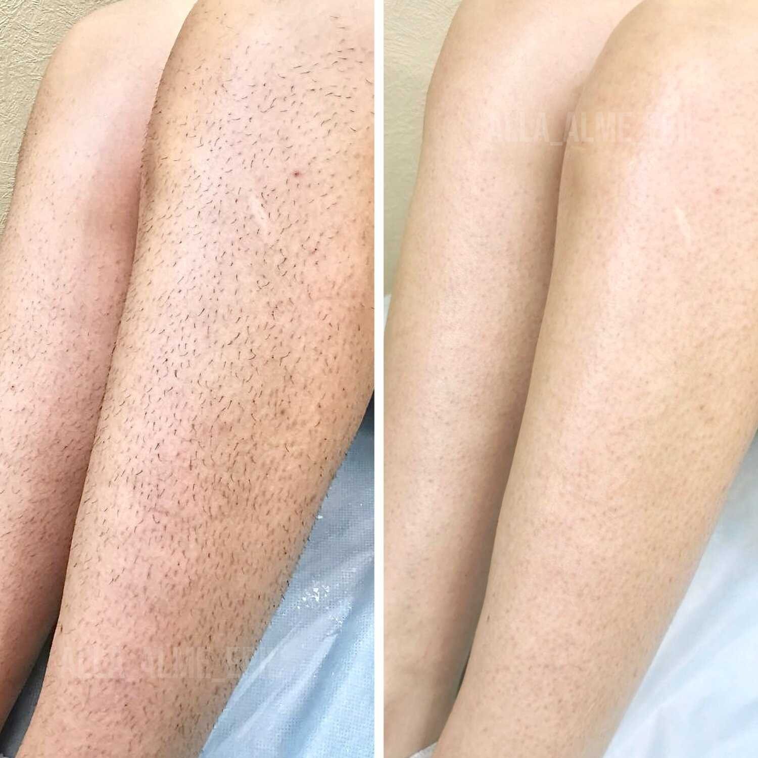 Преимущества шугаринга по сравнению с другими методами эпиляции