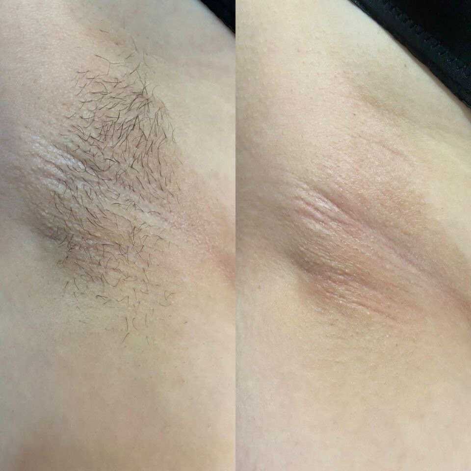 Как проходит процесс шугаринга: шаг за шагом