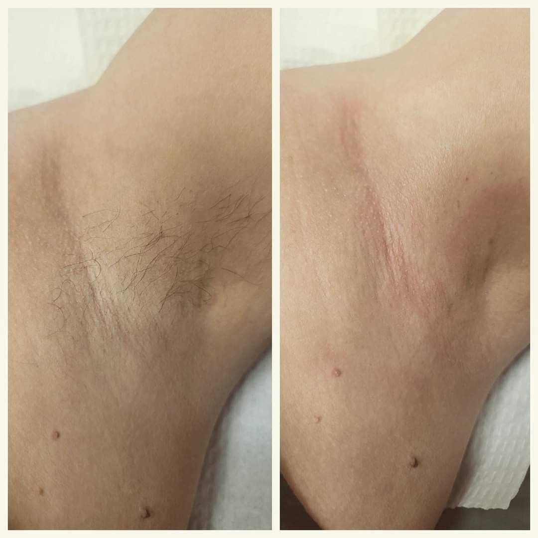 Что важно учесть перед проведением эпиляции