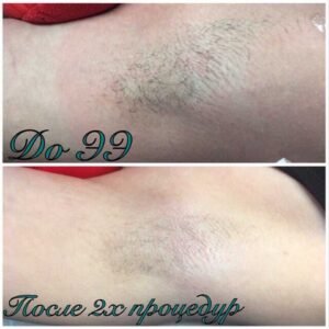 Удаление волос навсегда цена Ташкент