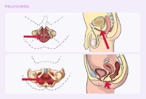 Упражнения Кегеля
